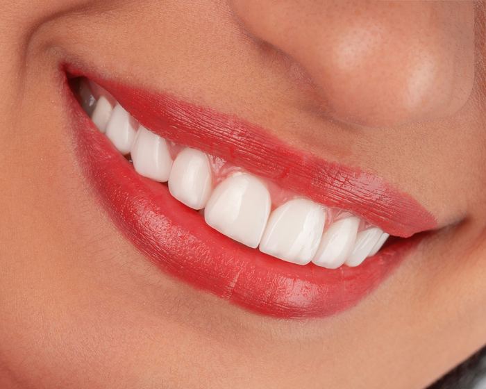 Close-up of bright white teeth after a professional teeth whitening session at Carte Blanche